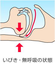 いびき・睡眠時無呼吸症候群の原因・舌と咽頭部分