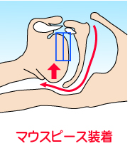 いびきと無呼吸症候群の気道を開くマウスピース・スリープスプリント